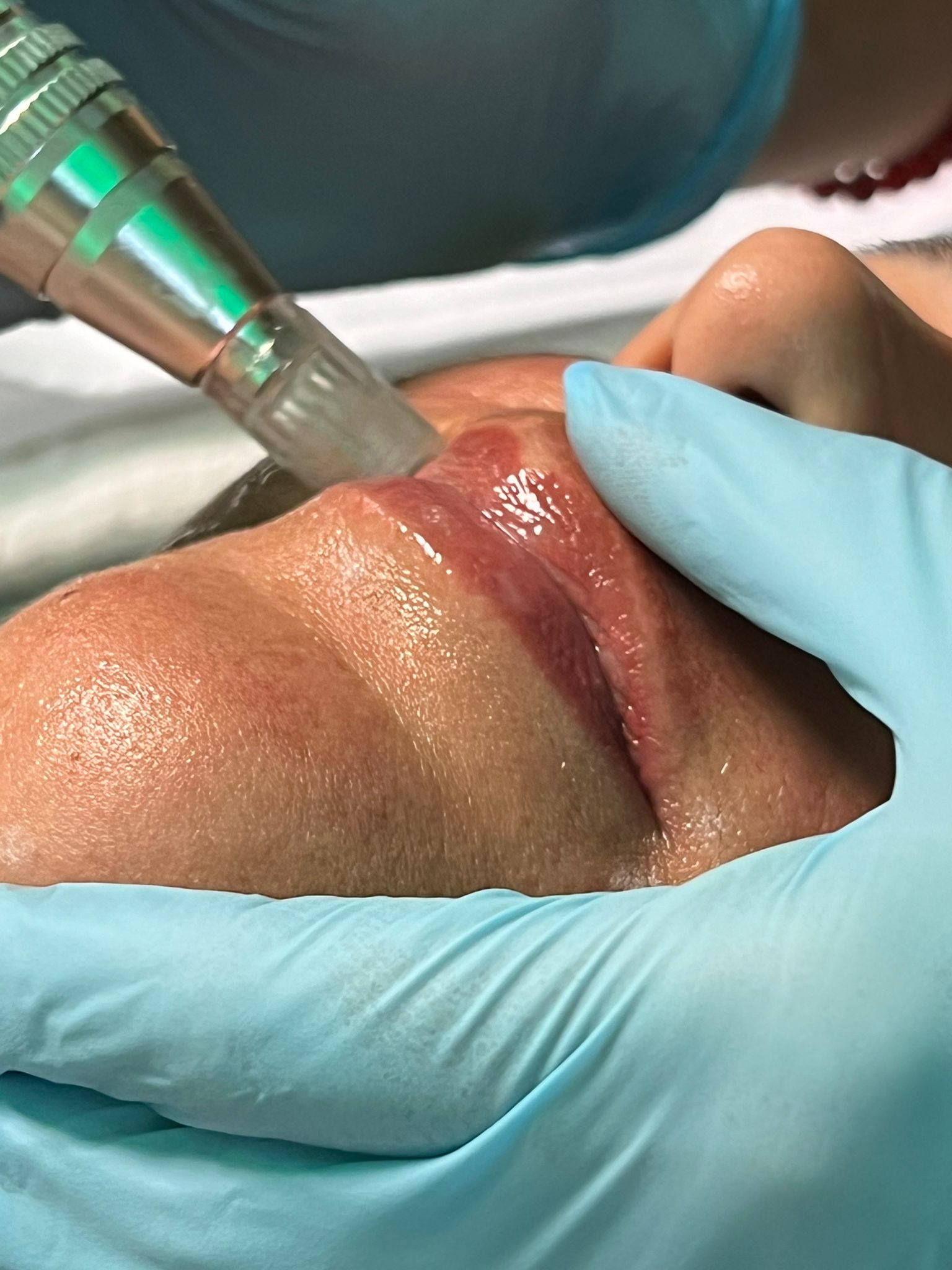 Taller de Microneedling: Hidratación y Rejuvenecimiento