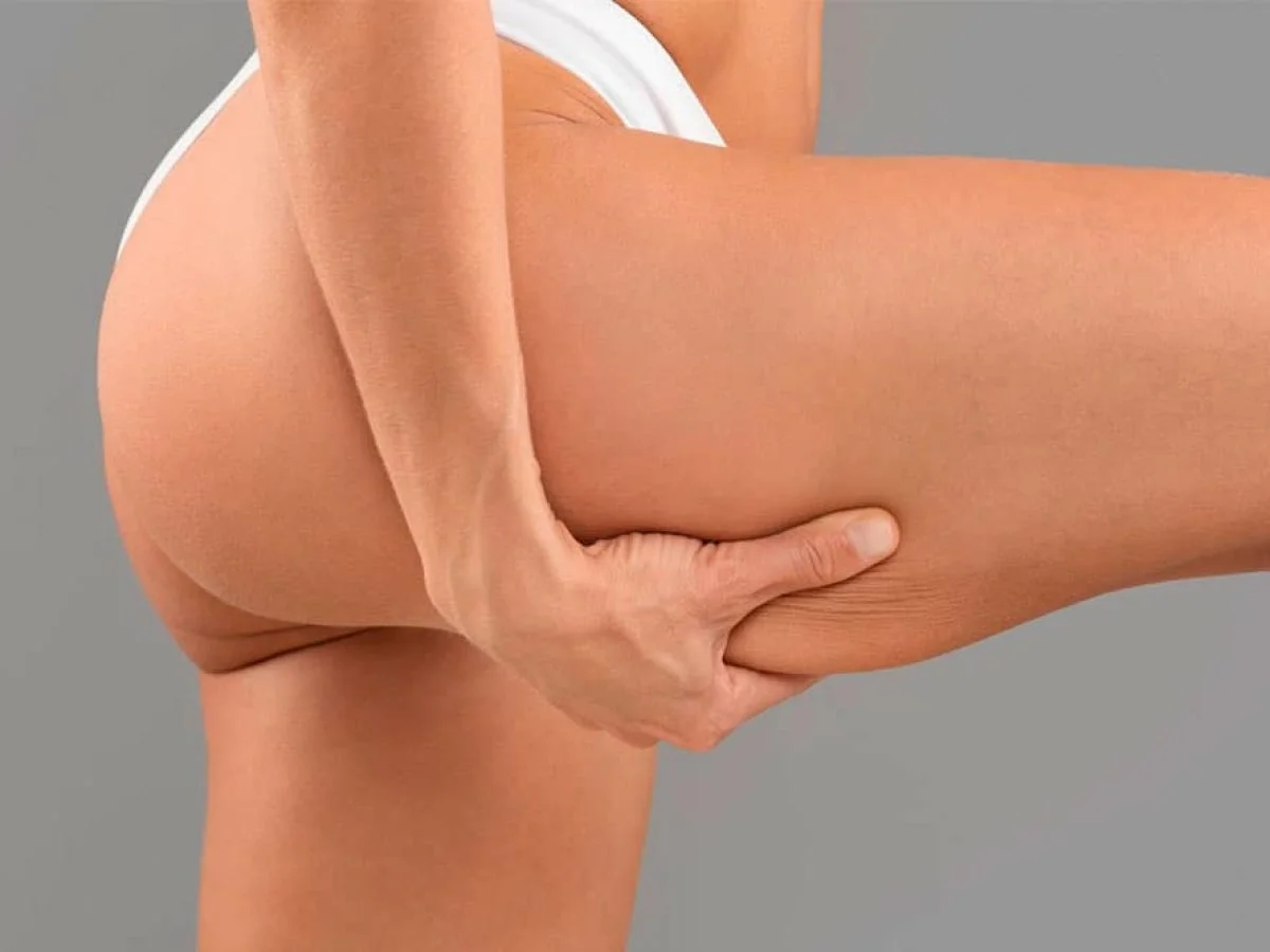 Entendiendo la Celulitis: Tratamientos Efectivos y Enfoques Prácticos